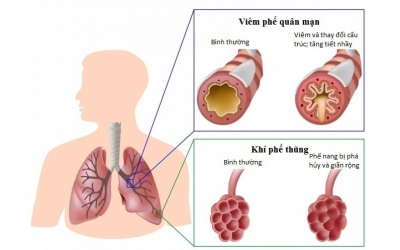 Lời khuyên đối với người bệnh mắc phổi tắc nghẽn mãn tính trong đại dịch Covid-19
